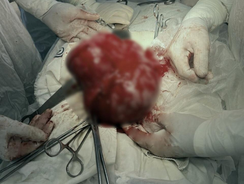 Воронежские врачи удалили пациентке гигантскую опухоль матки размером с ладонь