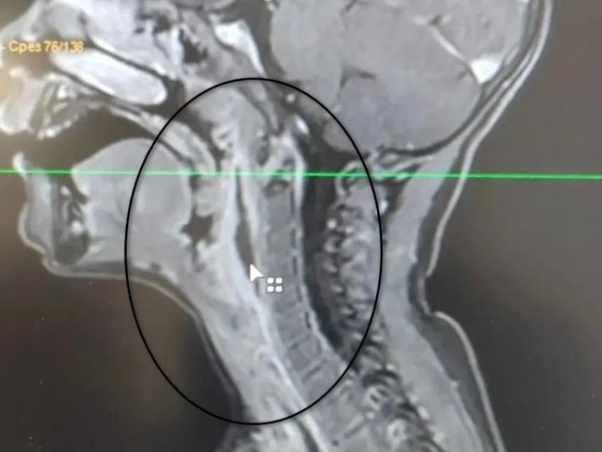 Двухлетнего мальчика с опасным скоплением гноя и высокой температурой поставили на ноги воронежские врачи
