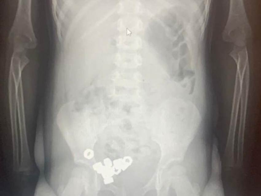 16 гаек проглотил трехлетний ребенок в Воронеже 