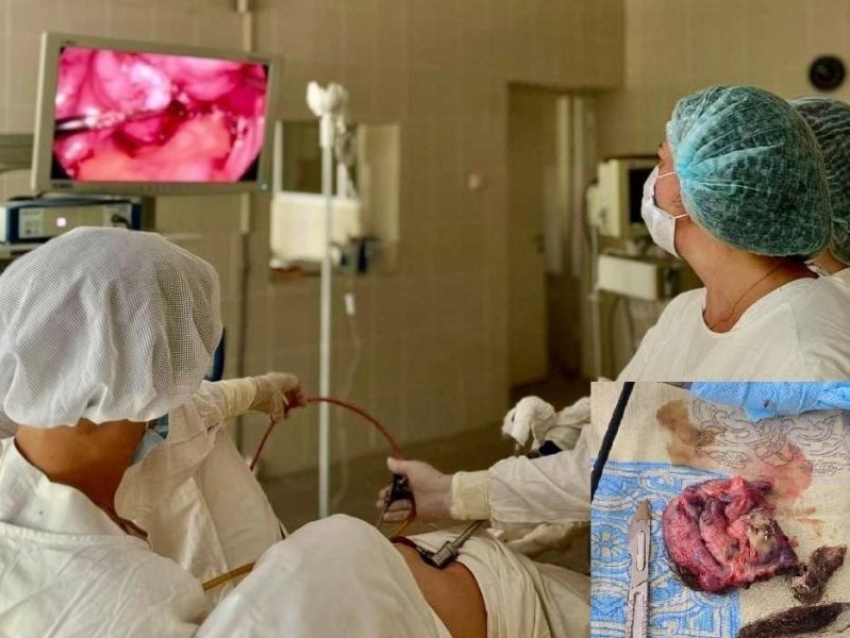 Кисту в 12 сантиметров удалили у женщины воронежские врачи