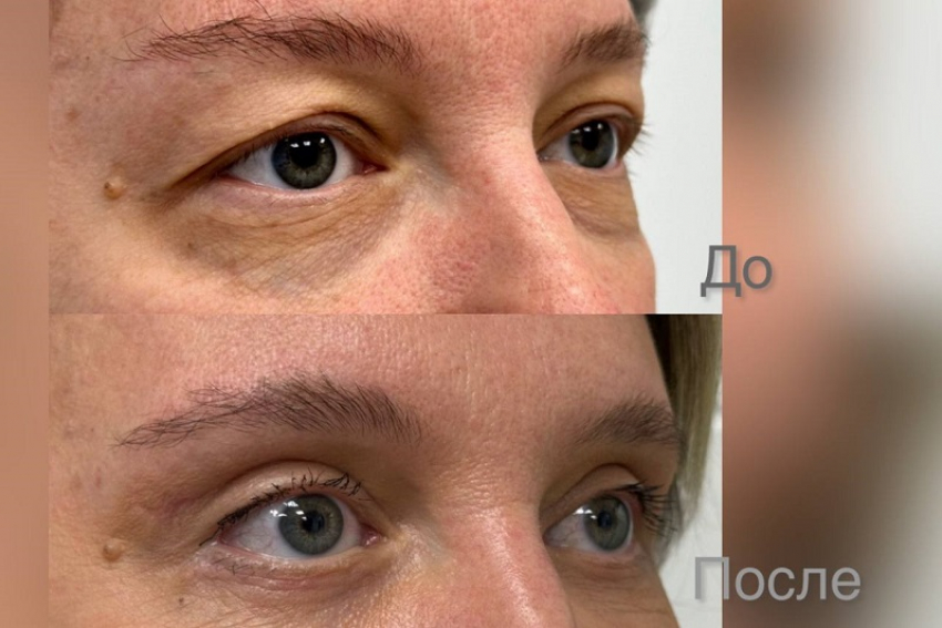 "Круговая» блефаропластика (верхняя+нижняя)  в клинике «Доктор Альбрехт"