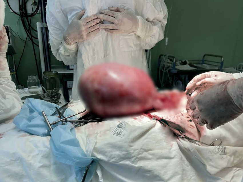 Опухоль размером с арбуз удалили 22-летней жительнице Воронежа
