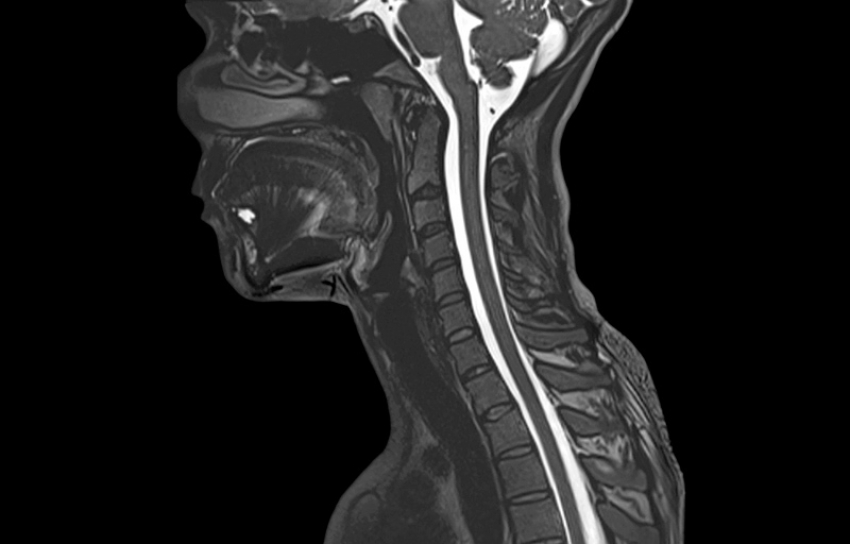 Особенности МРТ позвоночника