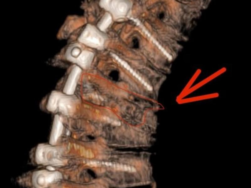 Воронежец получил серьезнейшую травму, нырнув в реку