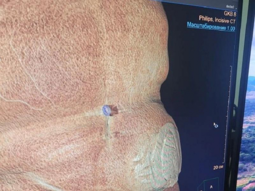Огромную грыжу удалили воронежские врачи у 79-летнего мужчины в БСМП №8