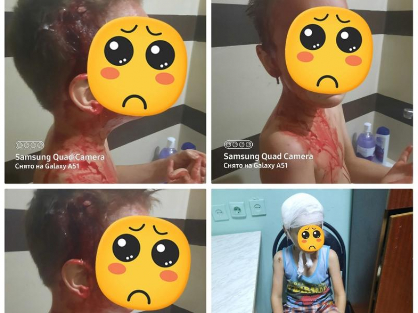 Мать показала рану на голове шестилетнего сына после нападения собаки под Воронежем