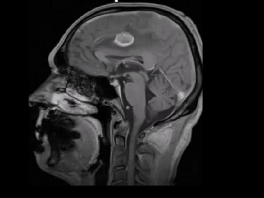 Мужчину с глубокой опухолью в центре мозга спасли воронежские медики