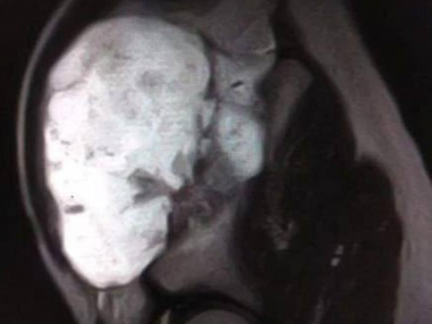  Гигантский нарост угрожал суставу: воронежские врачи спасли подростка