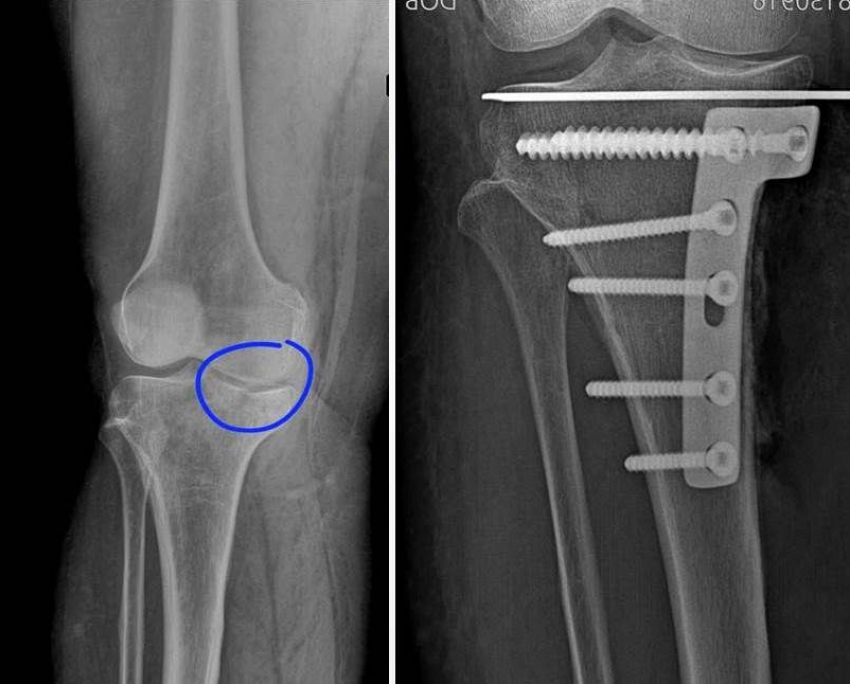 Воронежские врачи собрали ногу пациентки необычным способом  