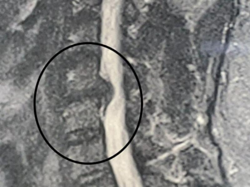 На грани паралича: воронежские нейрохирурги вернули к жизни руку пациента 