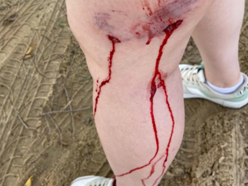 Кровавые последствия нападения бездомной собаки на женщину показали на фото под Воронежем