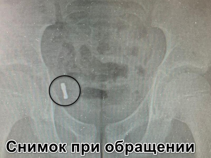 Съеденные магнитики попали в аппендикс маленького воронежца