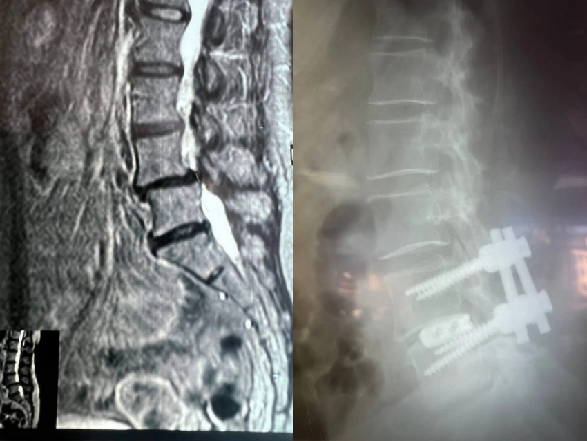 Воронежские медики вернули 61-летней пациентке возможность ходить без боли