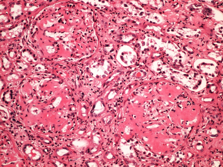 Средиземноморскую лихорадку выявили у воронежского пенсионера