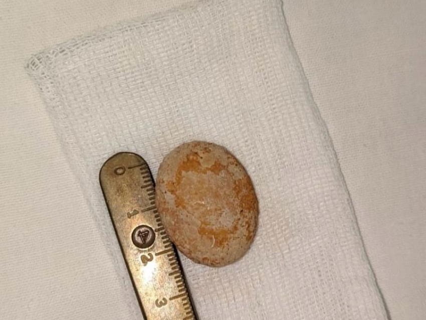 3-х сантиметровый камень извлекли из 1,5 месячного малыша в Воронеже