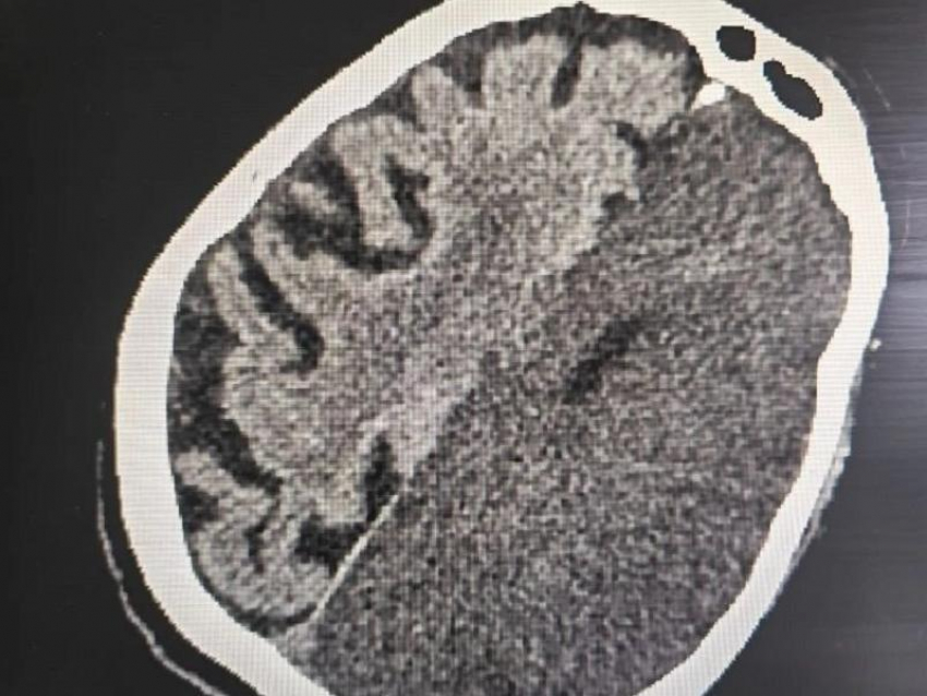 «Не было движений справа в теле»: врачи спасли жизнь пациентки с инсультом в Воронеже